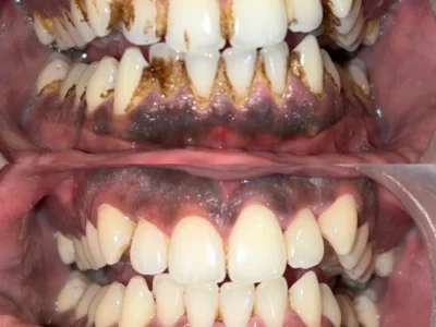 teeth whitening cost in pune