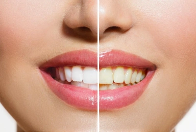 The Benefits of Professional Teeth Whitening