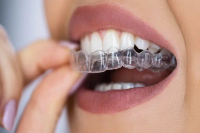 Top 10 Benefits of Choosing Invisalign Over Braces